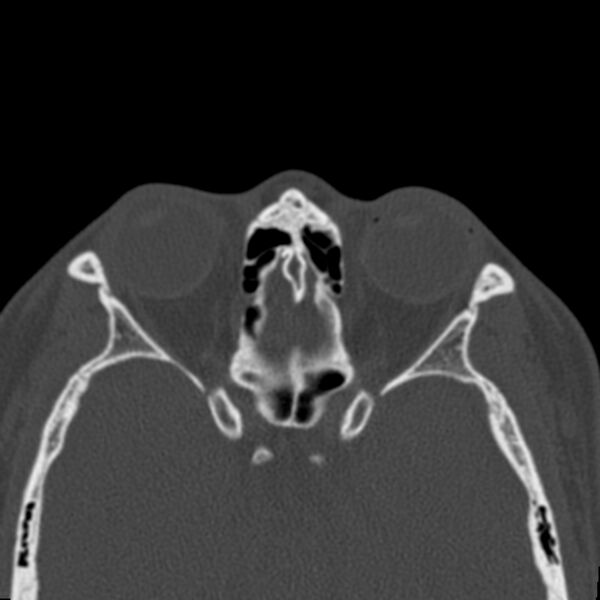 File:Antrochoanal polyp (Radiopaedia 21894-21868 Axial bone window 34).jpg