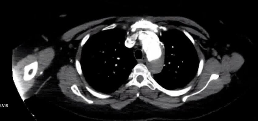 Aortic Dissection (Radiopaedia 85272-100847 A 13).jpg