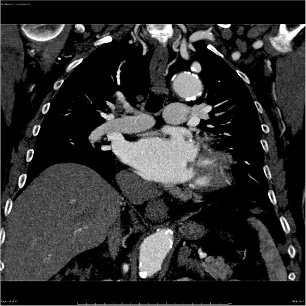 File:Aortic dissection - Stanford type A (Radiopaedia 26183-26315 A 34).jpg