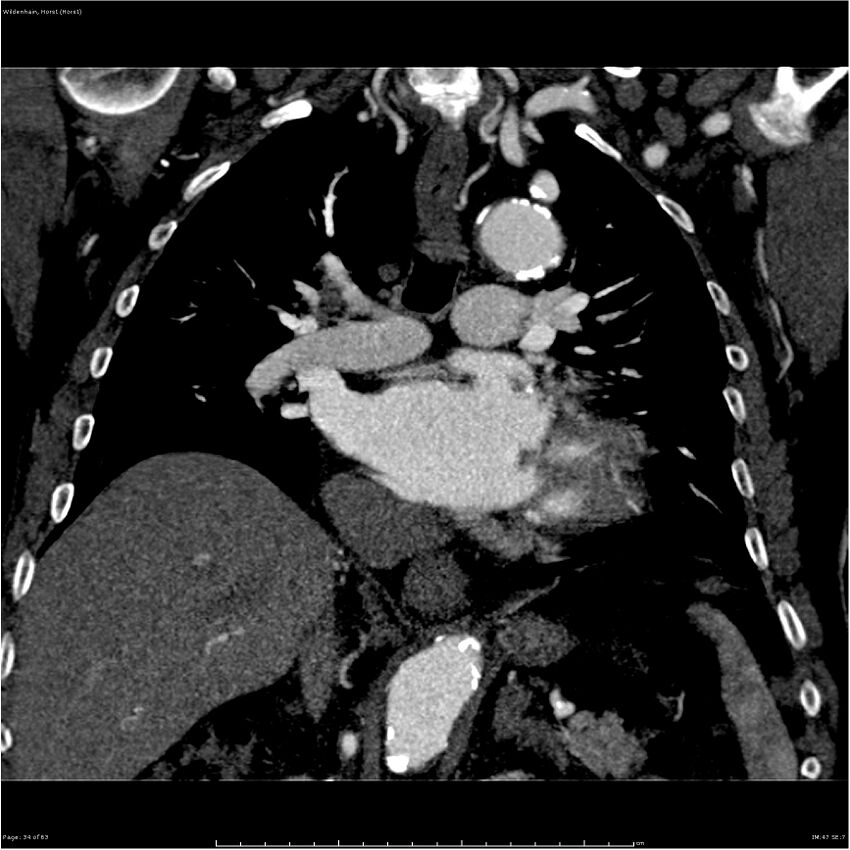 Aortic dissection - Stanford type A (Radiopaedia 26183-26315 A 34).jpg
