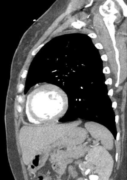 File:Aortic dissection - Stanford type B (Radiopaedia 50171-55512 C 4).png