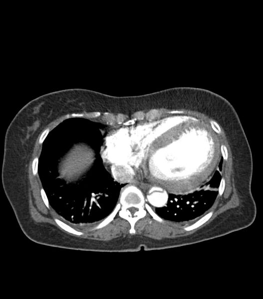 File:Aortic dissection with renal ischemia (Radiopaedia 76573-88338 A 49).jpg