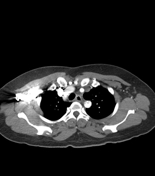 File:Aortic dissection with renal ischemia (Radiopaedia 76573-88338 A 9).jpg