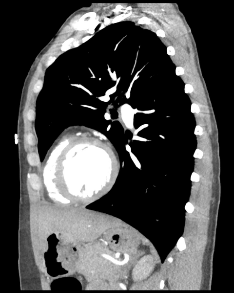 File:Aortic valve non-coronary cusp thrombus (Radiopaedia 55661-62189 D 21).png