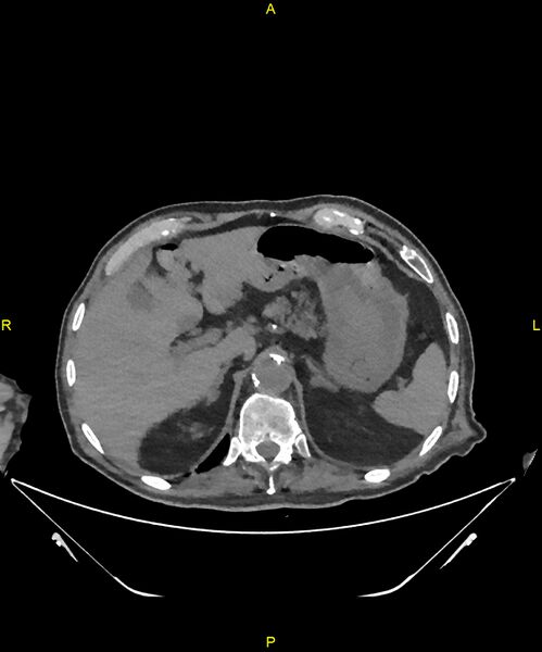 File:Aortoenteric fistula (Radiopaedia 84308-99603 Axial non-contrast 67).jpg