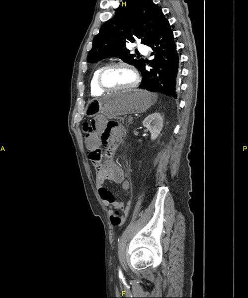 File:Aortoenteric fistula (Radiopaedia 84308-99603 C 238).jpg