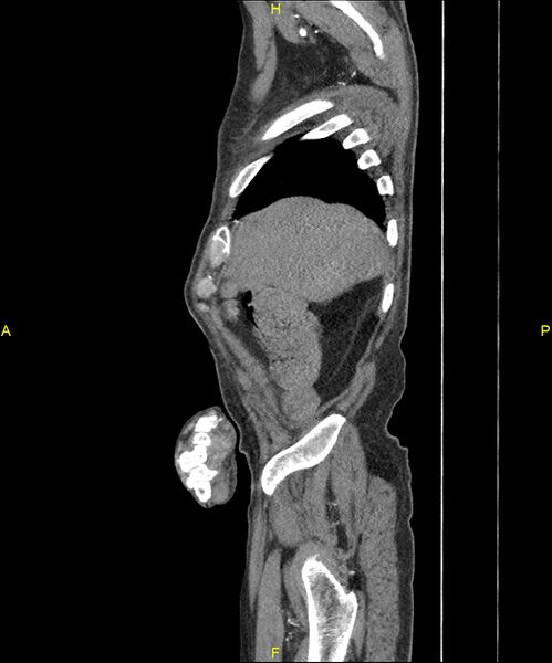 File:Aortoenteric fistula (Radiopaedia 84308-99603 C 47).jpg