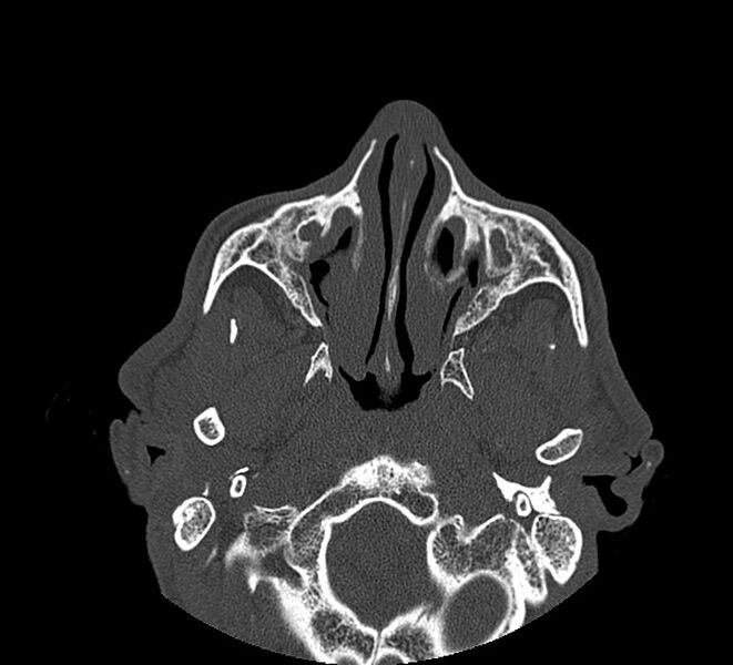 File:Aplastic maxillary sinuses (Radiopaedia 60030-67561 Axial non-contrast 28).jpg
