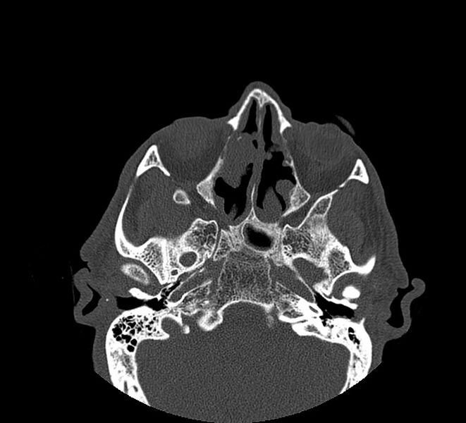 File:Aplastic maxillary sinuses (Radiopaedia 60030-67561 Axial non-contrast 39).jpg
