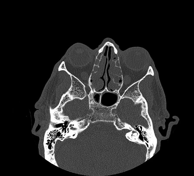 File:Aplastic maxillary sinuses (Radiopaedia 60030-67561 Axial non-contrast 42).jpg