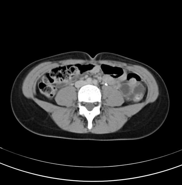 File:Appendicitis and incidental bicornuate uterus (Radiopaedia 22833-22853 Axial C+ delayed 21).jpg