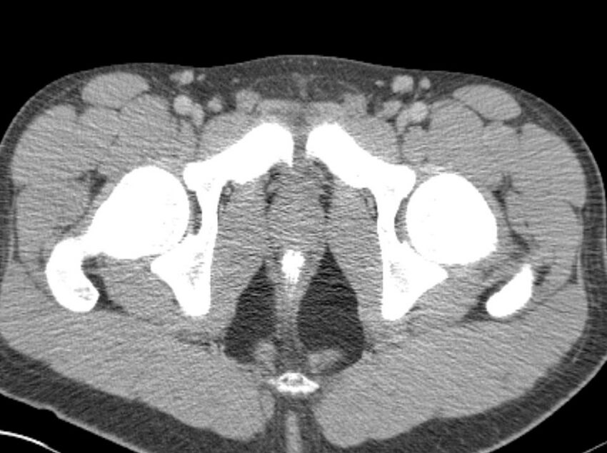 Appendicitis and incidental foregut duplication cyst (Radiopaedia 52962-58916 A 104).jpg