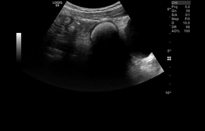 File:Appendicitis and incidental foregut duplication cyst (Radiopaedia 52962-58918 A 8).jpg