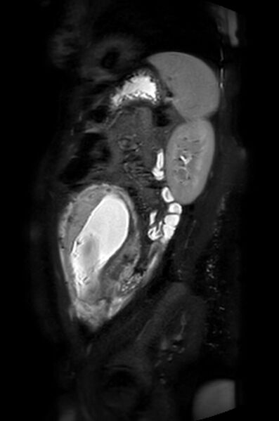 File:Appendicitis in gravida (MRI) (Radiopaedia 89433-106395 Sagittal T2 SPAIR 17).jpg