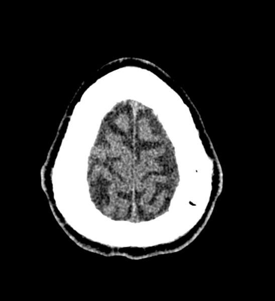 File:Arachnoid cyst of the ambient cistern (Radiopaedia 81301-94986 Axial non-contrast 65).jpg