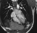 Arrhythmogenic right ventricular cardiomyopathy (Radiopaedia 39806-42237 D 113).jpg