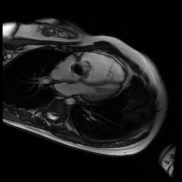 File:Arrhythmogenic right ventricular cardiomyopathy (Radiopaedia 87505-103850 4ch Cine SSFP 70).jpg