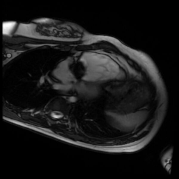 File:Arrhythmogenic right ventricular cardiomyopathy (Radiopaedia 87505-103850 4ch Cine SSFP 82).jpg