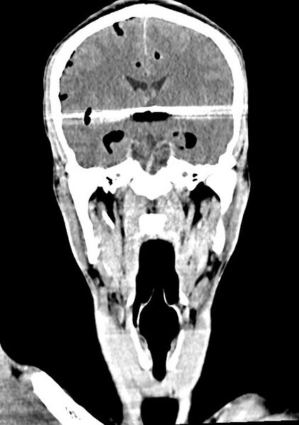 File:Arrow injury to the brain (Radiopaedia 72101-82607 Coronal non-contrast 40).jpg