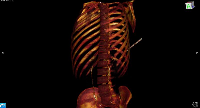 File:Arrow injury to the chest (Radiopaedia 75223-86321 3D bone 6).jpg