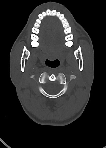 File:Arrow injury to the head (Radiopaedia 75266-86388 Axial bone window 33).jpg