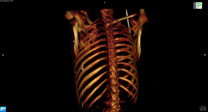 File:Arrow injury to the neck (Radiopaedia 75225-86323 3D bone 19).jpg