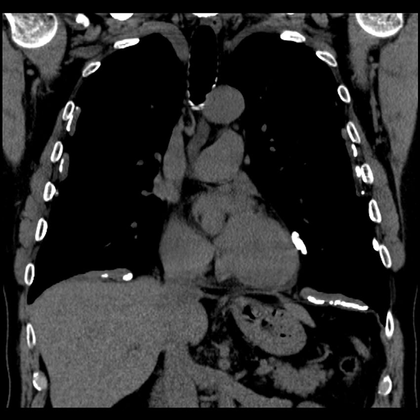 Asbestos-related pleural plaques (Radiopaedia 39069-41255 Coronal non-contrast 49).jpg