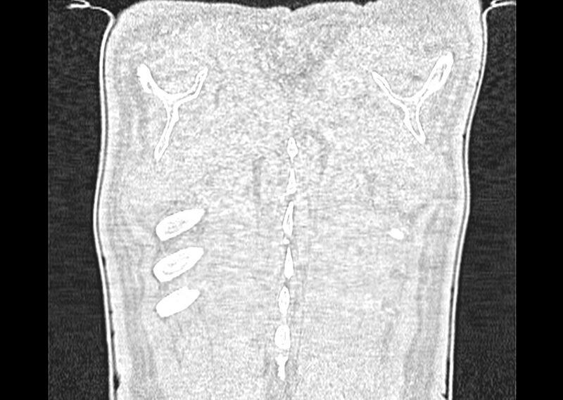File:Asbestos pleural placques (Radiopaedia 57905-64872 Coronal lung window 290).jpg