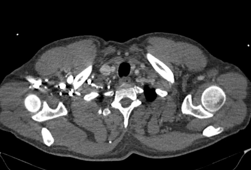 File:Ascending aortic aneurysm (Radiopaedia 86279-102297 C 1).jpg