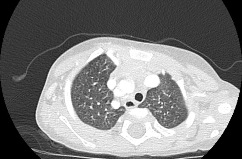 File:Asplenia syndrome (Radiopaedia 73083-83792 Axial lung window 12).jpg