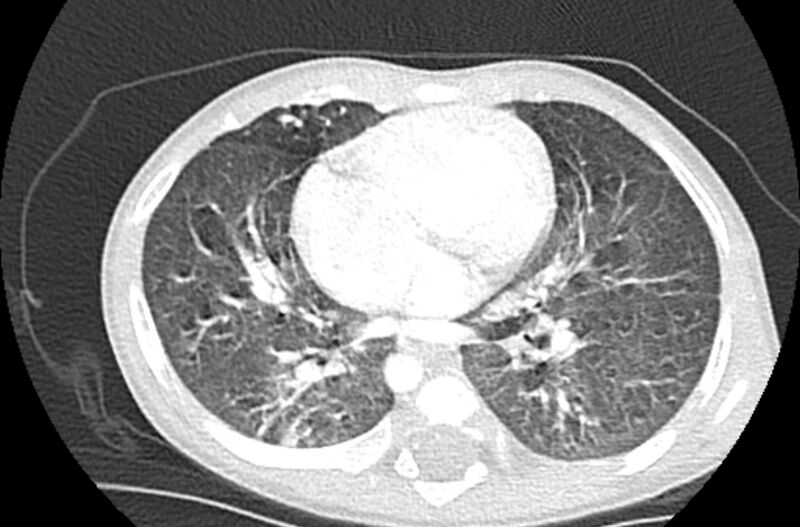 File:Asplenia syndrome (Radiopaedia 73083-83792 Axial lung window 41).jpg