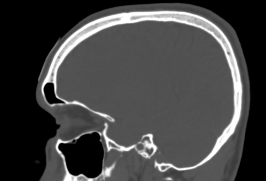 Asymptomatic occipital spur (Radiopaedia 87753-104201 Sagittal bone window 101).jpg
