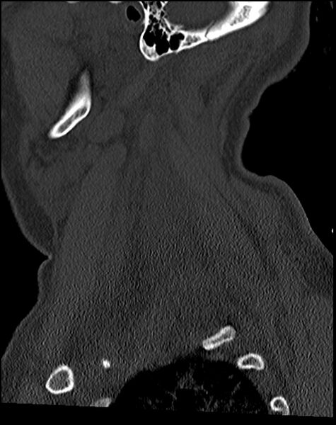 File:Atlanto-occipital dissociation - Traynelis type 1 (Radiopaedia 87570-103948 Sagittal bone window 68).jpg