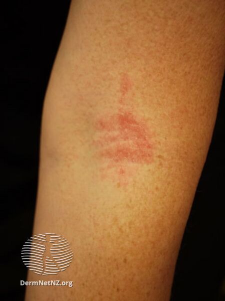 File:Atopic dermatitis (DermNet NZ dermatitis-flexural-eczema23).jpg