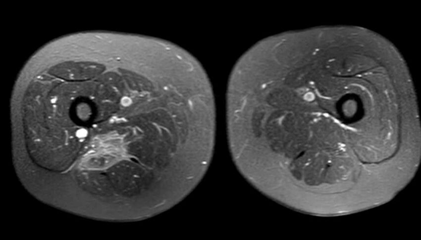 Atypical lipomatous tumor - thigh (Radiopaedia 68975-78734 Axial PD fat sat 59).jpg