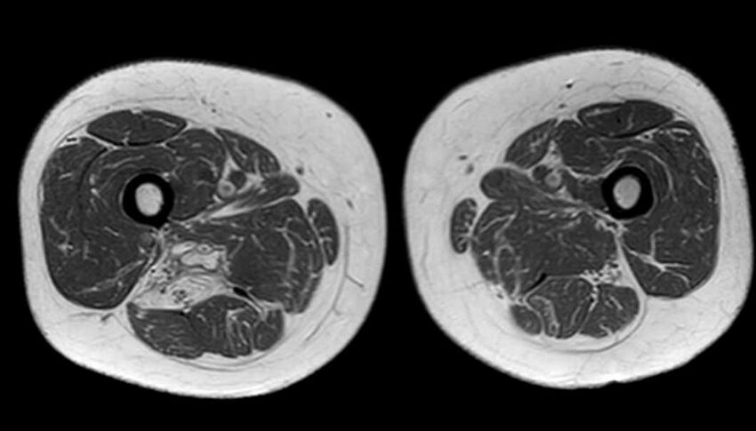 Atypical lipomatous tumor - thigh (Radiopaedia 68975-78734 Axial T1 57).jpg