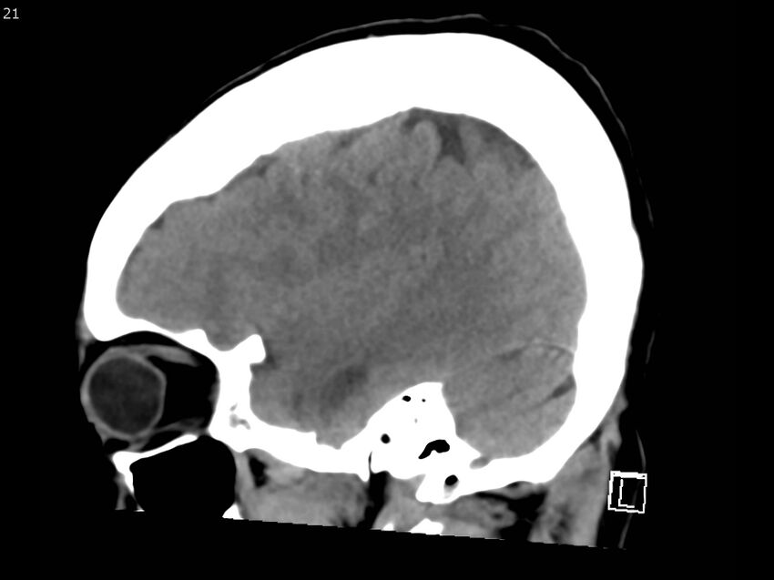 Atypical meningioma - intraosseous (Radiopaedia 64915-73867 C 19).jpg