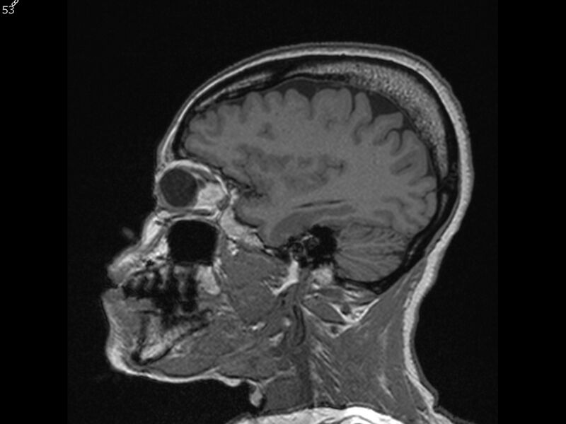 File:Atypical meningioma - intraosseous (Radiopaedia 64915-74572 Sagittal T1 53).jpg