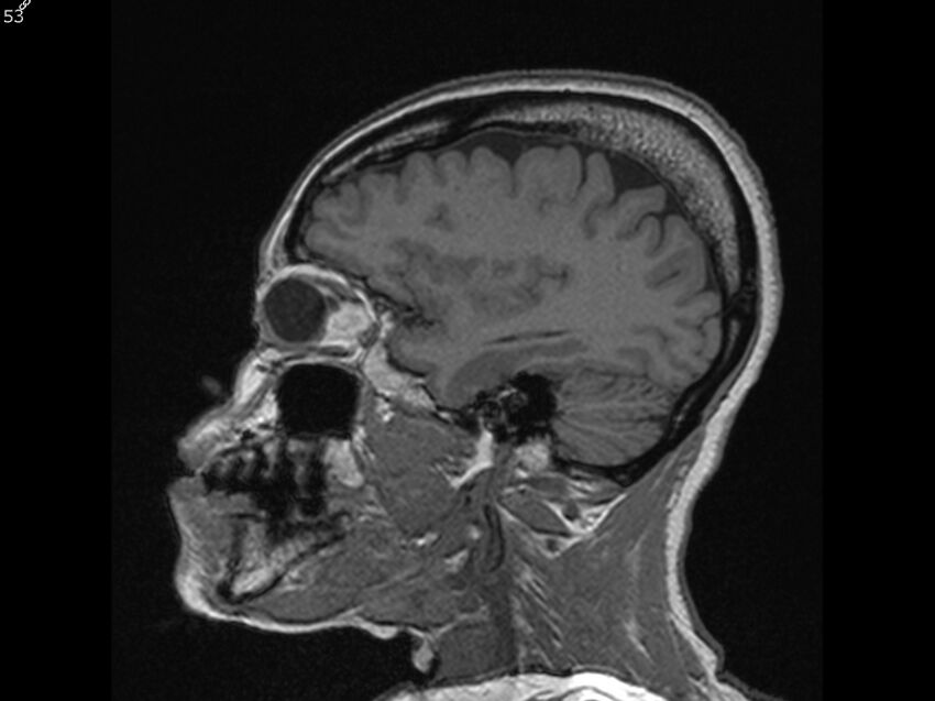 Atypical meningioma - intraosseous (Radiopaedia 64915-74572 Sagittal T1 53).jpg