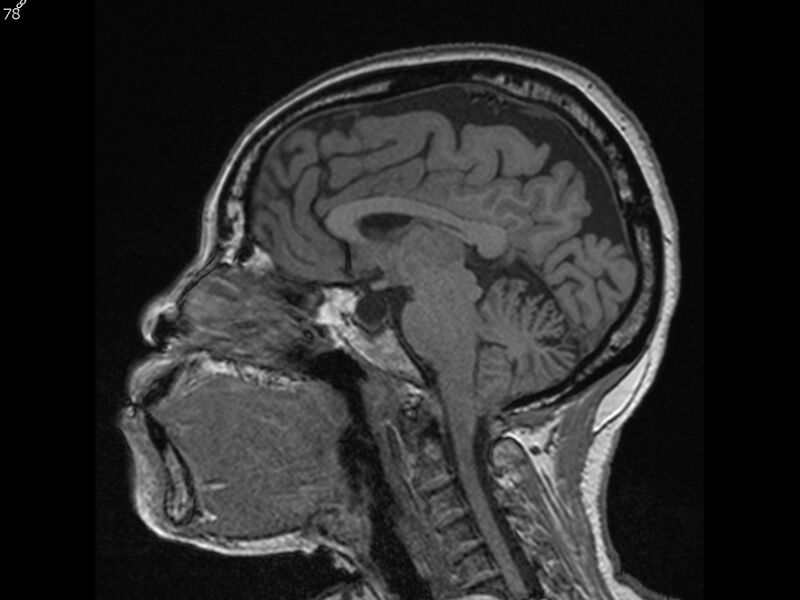File:Atypical meningioma - intraosseous (Radiopaedia 64915-74572 Sagittal T1 78).jpg