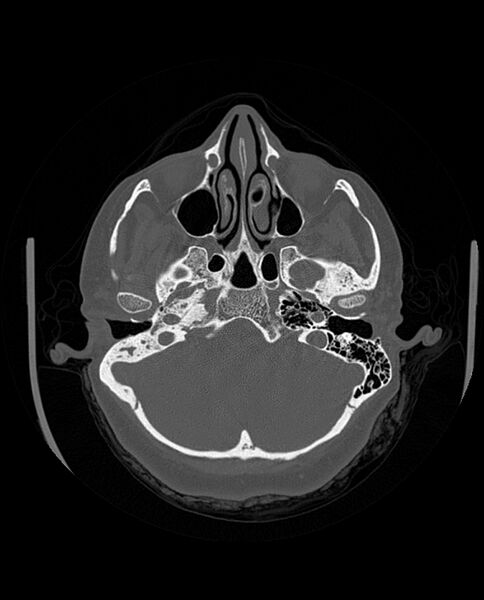 File:Automastoidectomy with labyrinthine fistula (Radiopaedia 84143-99411 Axial non-contrast 77).jpg