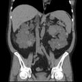 Autosomal dominant polycystic kidney disease (Radiopaedia 36539-38101 C 38).jpg
