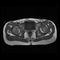 Avascular necrosis of the hip (Radiopaedia 29563-30067 Axial T1 8).jpg