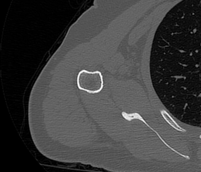 File:Avulsion fracture - greater tuberosity of humerus (Radiopaedia 71216-81514 Axial bone window 58).jpg