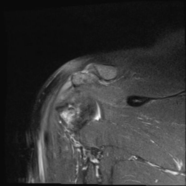 File:Avulsion fracture - greater tuberosity of humerus (Radiopaedia 71216-81515 Coronal PD fat sat 7).jpg