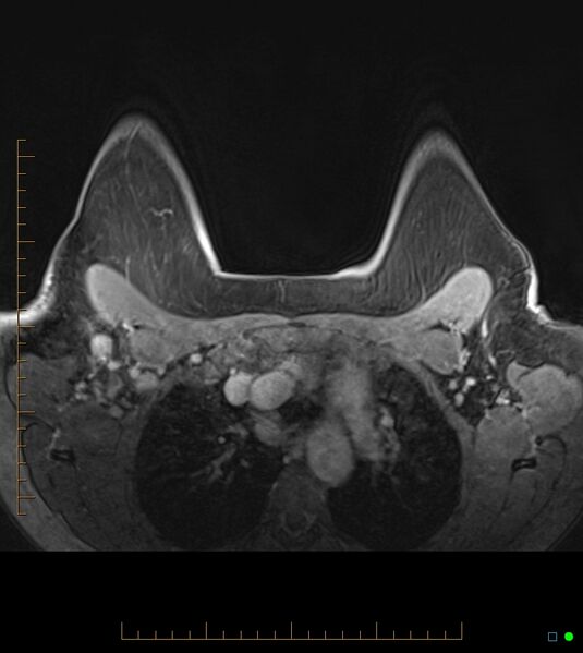 File:Axillary lymphadenopathy on breast MRI- yellow fever vaccination induced (Radiopaedia 19454-19483 Axial T1 C+ fat sat 20).jpg