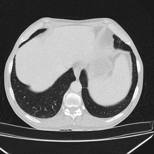 File:Azygos lobe (Radiopaedia 38259-40275 Axial lung window 69).jpg