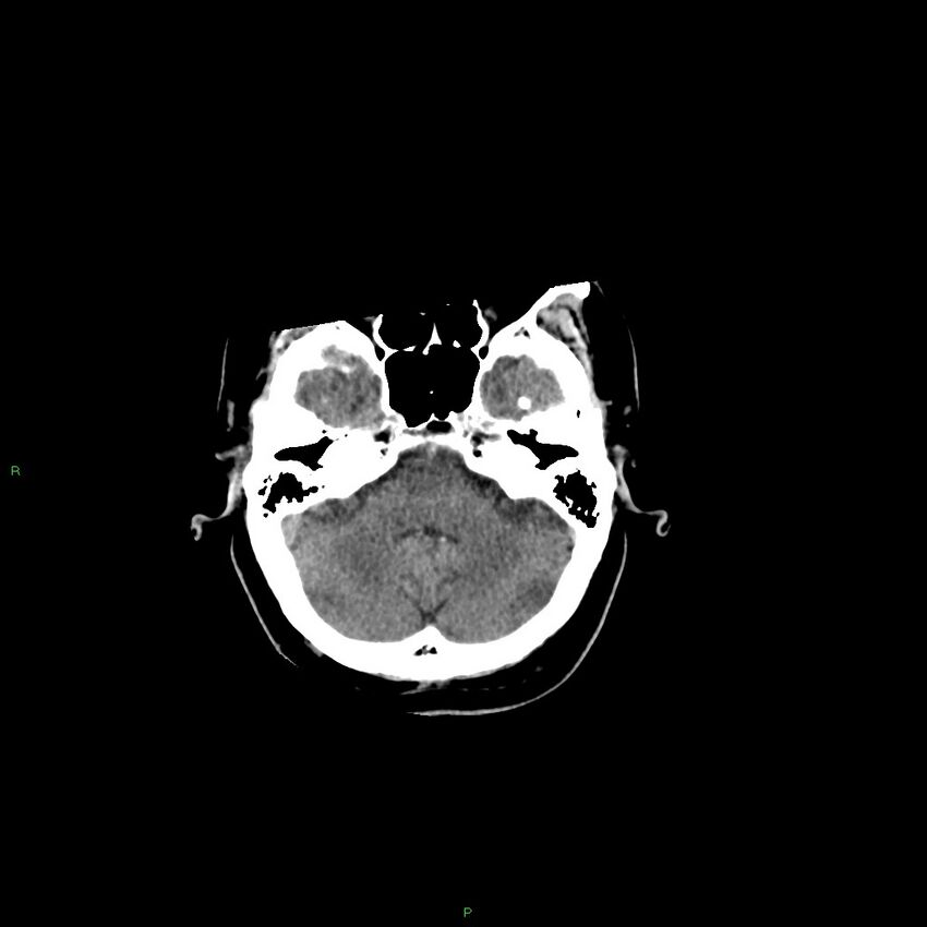 Basal ganglia hemorrhage (Radiopaedia 58346-65467 Axial non-contrast 45).jpg