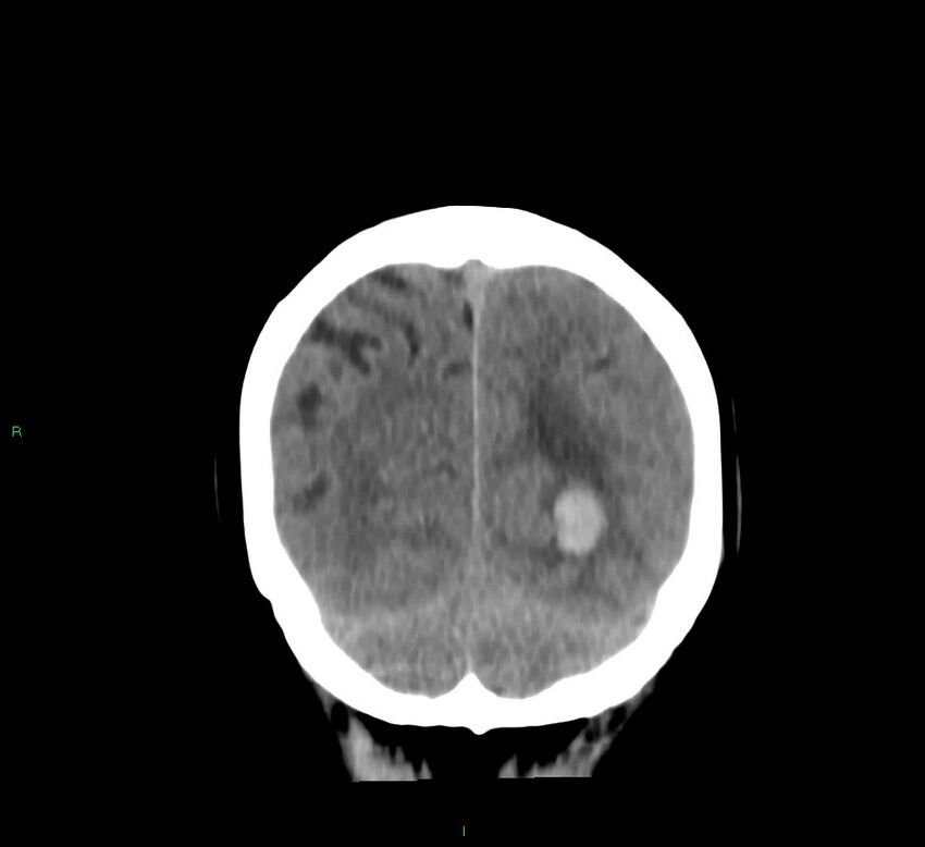 Basal ganglia hemorrhage (Radiopaedia 58767-65989 Coronal non-contrast 16).jpg