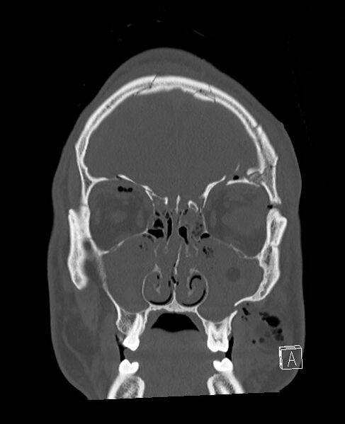 File:Base of skull fracture with bilateral Le Fort fractures (Radiopaedia 47094-51638 Coronal bone window 76).jpg